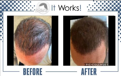 Best-Scalp-Micropigmentation-For-Long-Hair.jpg