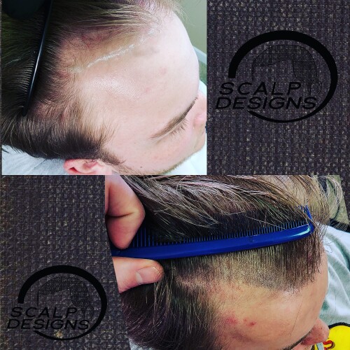 Best-Scalp-Micropigmentation-For-Long-Hair.jpg