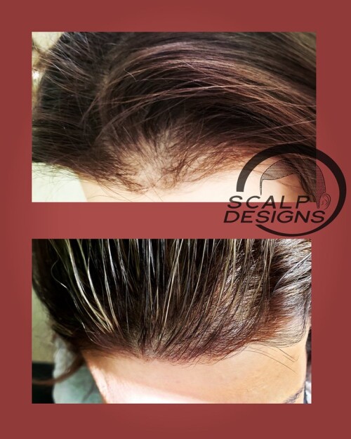 Hairline-Shapes-For-Women-Scalps.jpg