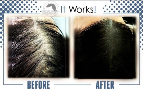 Best-Scalp-Micropigmentation-For-Long-Hair.jpg