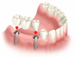 Dental-Bridges-in-Chicago-IL.jpg