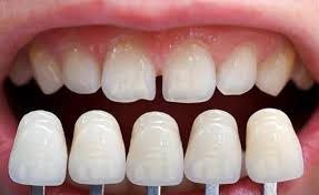 Unveiling-the-Best-Dental-Veneers-in-Kennesaw-GA.jpg