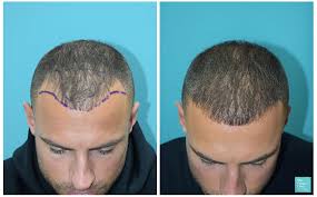 The-Best-Hair-Loss-Clinic-in-Boston.jpg
