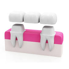Dental-Bridges-in-Chicago-IL.jpg