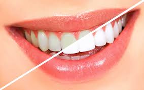 Teeth-Whitening-Clinic-in-Kennesaw-GA.jpg