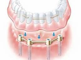 The-Ultimate-Choice-for-Implant-Dentures-in-Republic-MO.jpg