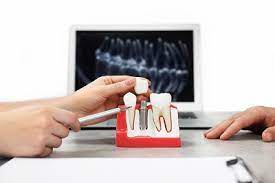 Dental-Implants-Lakewood-Ranch.jpg