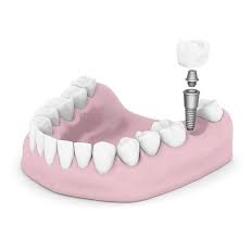 The-Ultimate-Choice-for-Implant-Dentures-in-Republic-MO.jpg