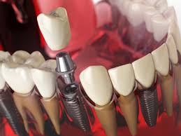 Explore-Dental-Implants-in-Chicago-IL.jpg