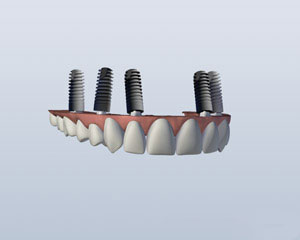 upperdenture.jpg
