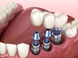 Dental-Implants-Lakewood-Ranch.jpg