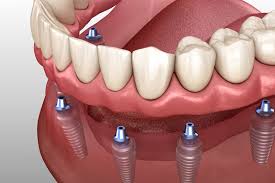 The-Ultimate-Choice-for-Implant-Dentures-in-Republic-MO.jpg