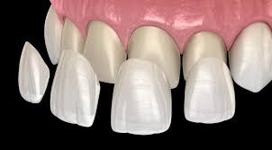 Enhance-Your-Smile-with-Dental-Veneers-in-Greenbrier-TN.jpg